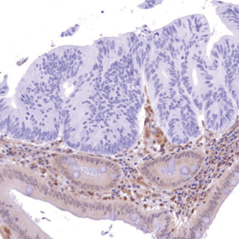 Image: SP218 staining PTEN loss on colon adenocarcinoma sample (Photo courtesy of Spring Bioscience, Inc.).